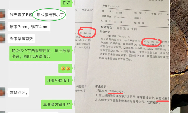 桑黃能治甲狀腺結節案例